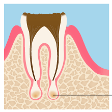 虫歯によりひきおこされた歯周炎