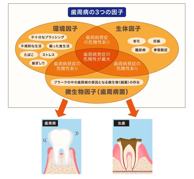 歯周病3つの原因