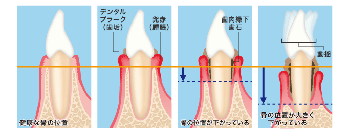 歯周ポケットの図