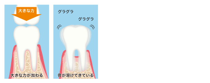 グラグラ骨が溶けてきている