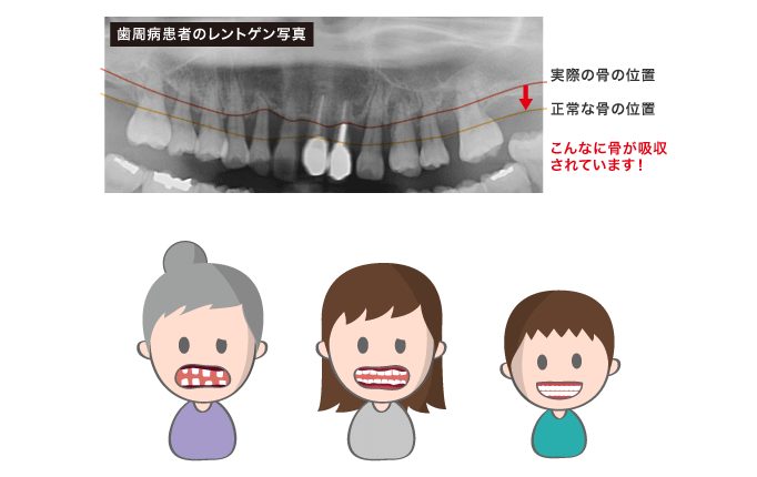 歯周病患者のレントゲン写真
