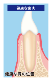 健康な歯肉