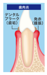 歯肉炎