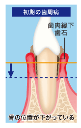 初期の歯周病