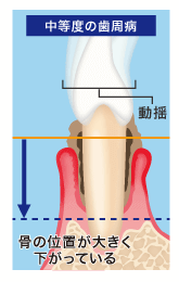 中等度の歯周病