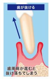 歯が抜ける
