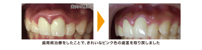 歯周病治療をしたことで、きれいなピンク色の歯茎を取り戻しました