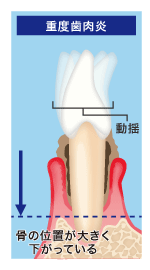 重度歯肉炎