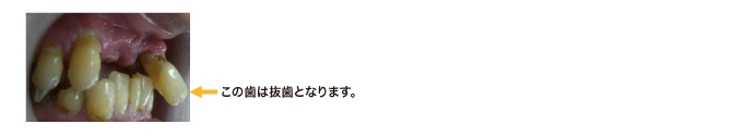 この歯は抜歯となります