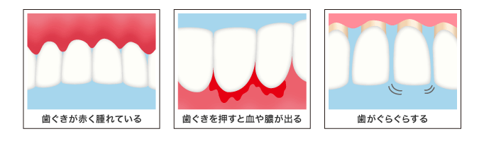 歯ぐきが赤く腫れている、歯ぐきを押すと血や膿が出る、歯がぐらぐらする