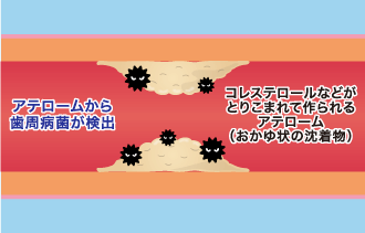 歯周病菌が心筋梗塞を引き起こすまで