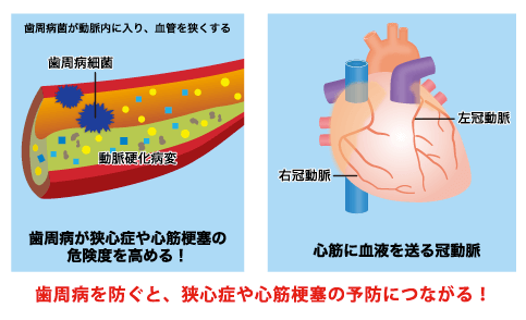 歯周病菌が心筋梗塞を引き起こすまで