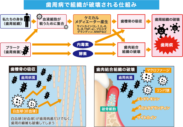 歯周病の原因《歯垢（プラーク）・歯石》