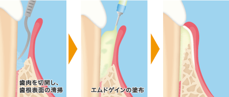 エムドゲイン法