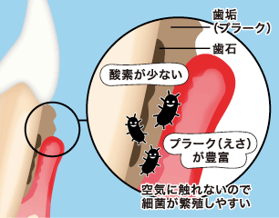 歯石をとる