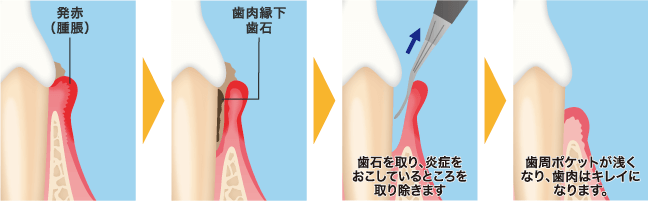 歯周ポケット掻把術