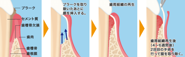 GTR法（歯周組織再生療法）