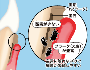 空気に触れないので細菌が繁殖しやすい