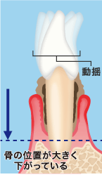 骨の位置が大きく下がっている