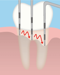 歯周病の検査について