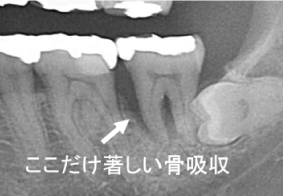 著しい骨吸収