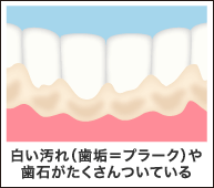 白い汚れ（歯垢＝プラーク）や歯石がたくさんついている