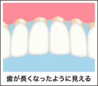 歯が長くなったように見える