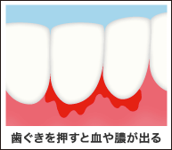 歯ぐきを押すと血や膿が出る