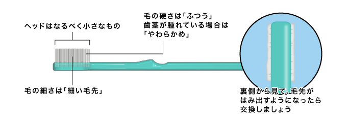 歯周病予防におすすめな歯ブラシの種類