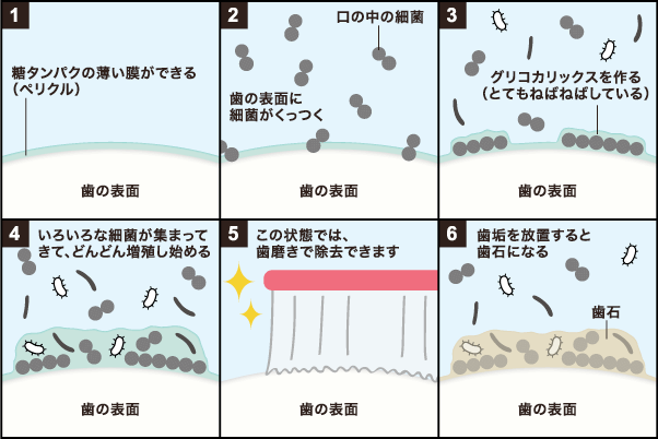 なぜ歯石がたまるのか?