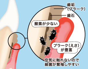 歯石があったらなぜ悪いのか?