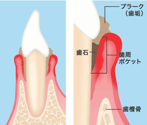 歯石があったらなぜ悪いのか?