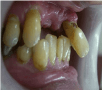 歯周病が悪化すれば抜歯になる事もあります