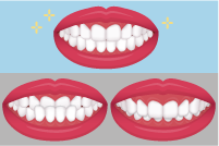 上顎の前歯が適度に下顎の前歯を隠している