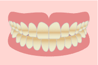 歯の色素沈着の原因 テトラサイクリン