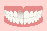 歯の色素沈着の原因 歯の神経が死んでしまっている