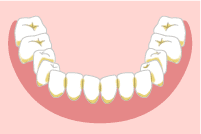 歯の色素沈着の対処法 歯石