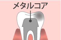 歯の色素沈着の対処法 詰め物や被せ物