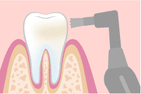 歯の色素沈着の対処法 歯のクリーニング