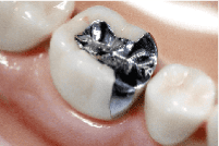 歯の色素沈着の対処法 レジン前装金属冠