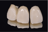 歯の色素沈着の対処法 CAD/CAM冠