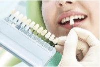 歯の色素沈着の対処法 ポーセレンラミネートベニア
