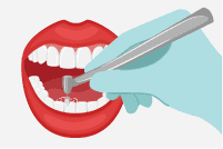 歯の色素沈着の対処法 PMTC