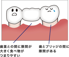 歯茎との間に隙間が大きく食べ物がつまりやすい