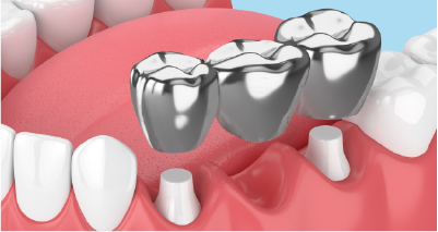 奥歯のブリッジは銀歯を使用