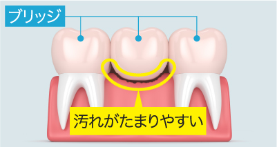 奥歯は、食べかすが溜まりやすく落としづらい