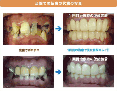 当院での仮歯の状態の写真