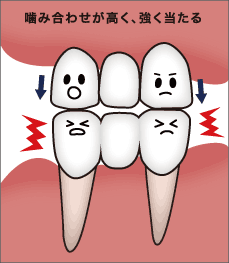 噛み合わせが高く、強く当たる