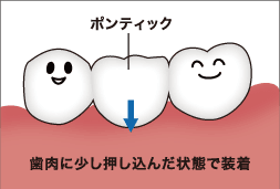 歯肉に少し押し込んだ状態で装着