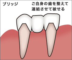 ブリッジの場合